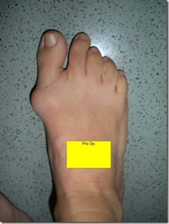 Bunion Surgery Before and After