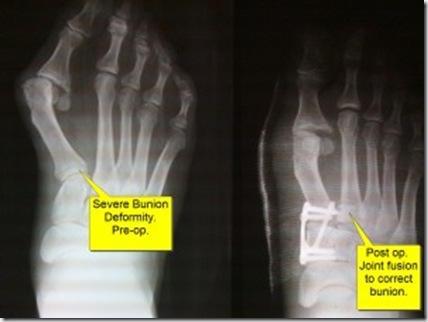 Bunion Surgery Before and After