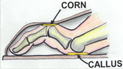 Hammertoe anatomy