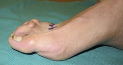 Best Hammertoe surgery Before and After Pictures 05