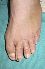 Best Hammertoe surgery Before and After Pictures 09