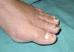 Best Hammertoe surgery Before and After Pictures 10