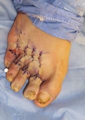 Best Hammertoe surgery Before and After Pictures 12