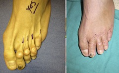 Best Hammertoe surgery Before and After Pictures 13