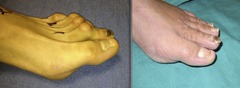 Best Hammertoe surgery Before and After Pictures 14