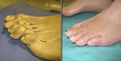 Best Hammertoe surgery Before and After Pictures 15