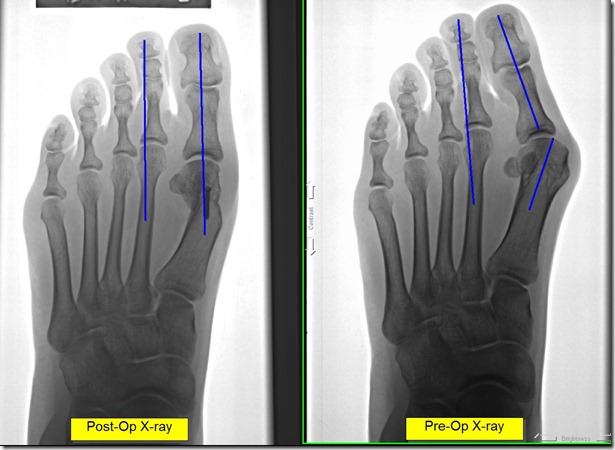 Post op x-ray of painful bunion 9