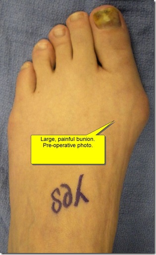 Pre operative photo of painful bunion 2