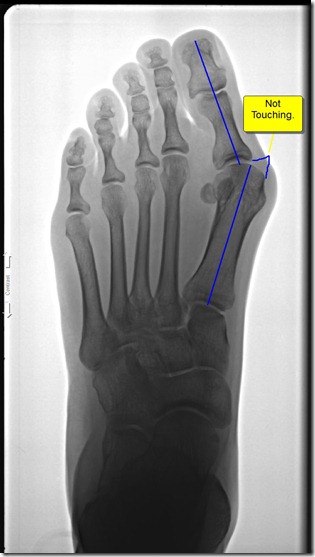 Pre operative x-ray of painful bunion 3
