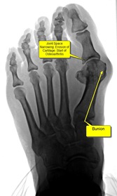 Best Podiatrist Bunion Surgery without pain joint space narrowing1