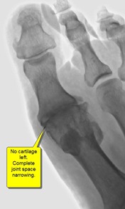 Best Podiatrist Bunion Surgery without pain joint space narrowing3