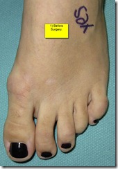 Hammertoe Surgery Before and After Pictures 01