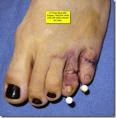 Hammertoe Surgery Before and After Pictures 02