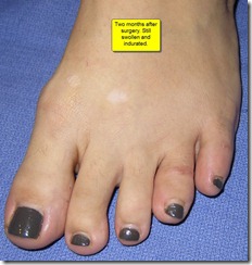 Hammertoe Surgery Before and After Pictures 03