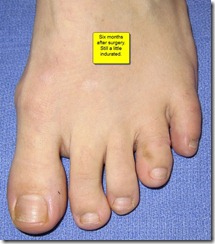 Hammertoe Surgery Before and After Pictures 04