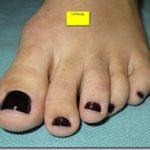 Hammertoe-Surgery-Before-and-After-Pictures-05_thumb