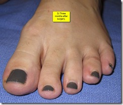 Hammertoe Surgery Before and After Pictures 07