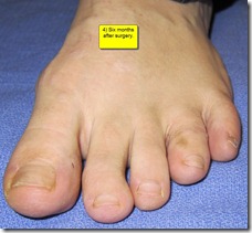Hammertoe Surgery Before and After Pictures 08