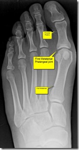 Pain in great toe joint Hallux Limitus p01