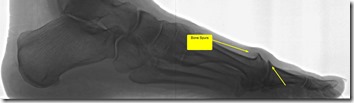 Pain in great toe joint Hallux Limitus p02