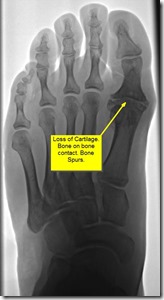 Pain in great toe joint Hallux Limitus p03