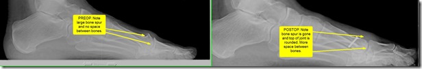 Pain in great toe joint Hallux Limitus p06