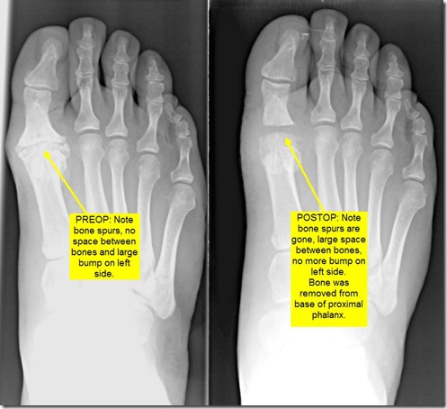 Pain in great toe joint Hallux Limitus p07