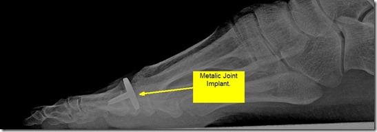 Pain in great toe joint Hallux Limitus p08