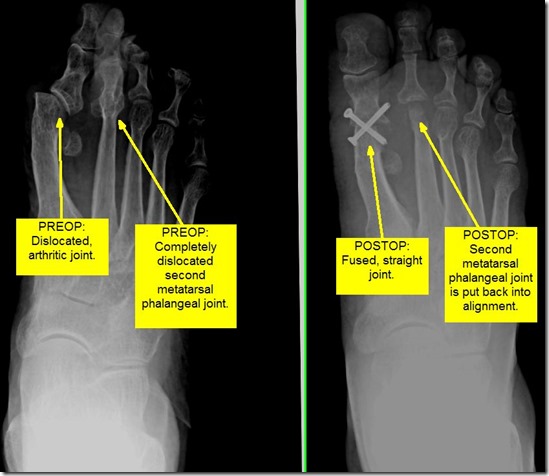 Pain in great toe joint Hallux Limitus p09