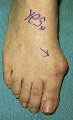 Large bunion surgery before and after pictures p01