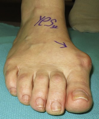 Large bunion surgery before and after pictures p02