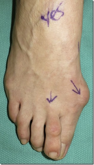 Large bunion with overlapping second toe before and after pictures p08
