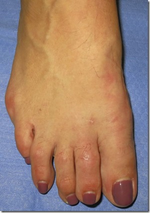 Large bunion with overlapping second toe before and after pictures p09