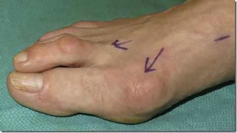 Large bunion with overlapping second toe before and after pictures p10