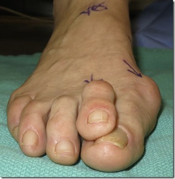 Large bunion with overlapping second toe before and after pictures p12