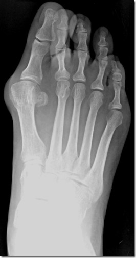 Large bunion with overlapping second toe before and after pictures p14