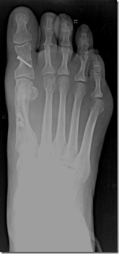 Large bunion with overlapping second toe before and after pictures p15