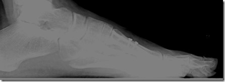 Large bunion with overlapping second toe before and after pictures p17