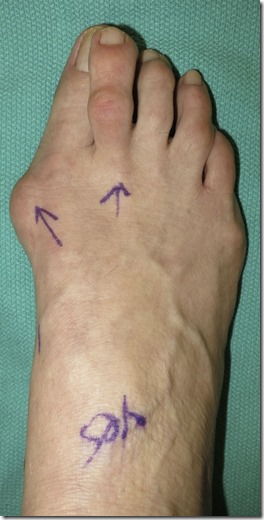 Large bunion with overlapping second toe p01