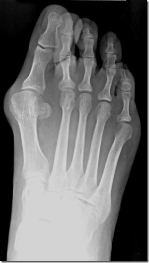Large bunion with overlapping second toe p02