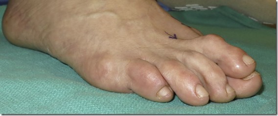 Large bunion with overlapping second toe p03