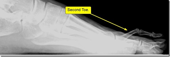 Large bunion with overlapping second toe p04
