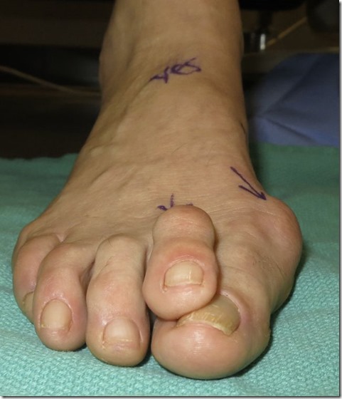 Large bunion with overlapping second toe p05