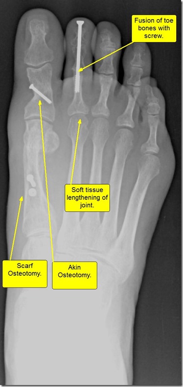 Large bunion with overlapping second toe p06