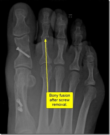 dislocated second toe surgery