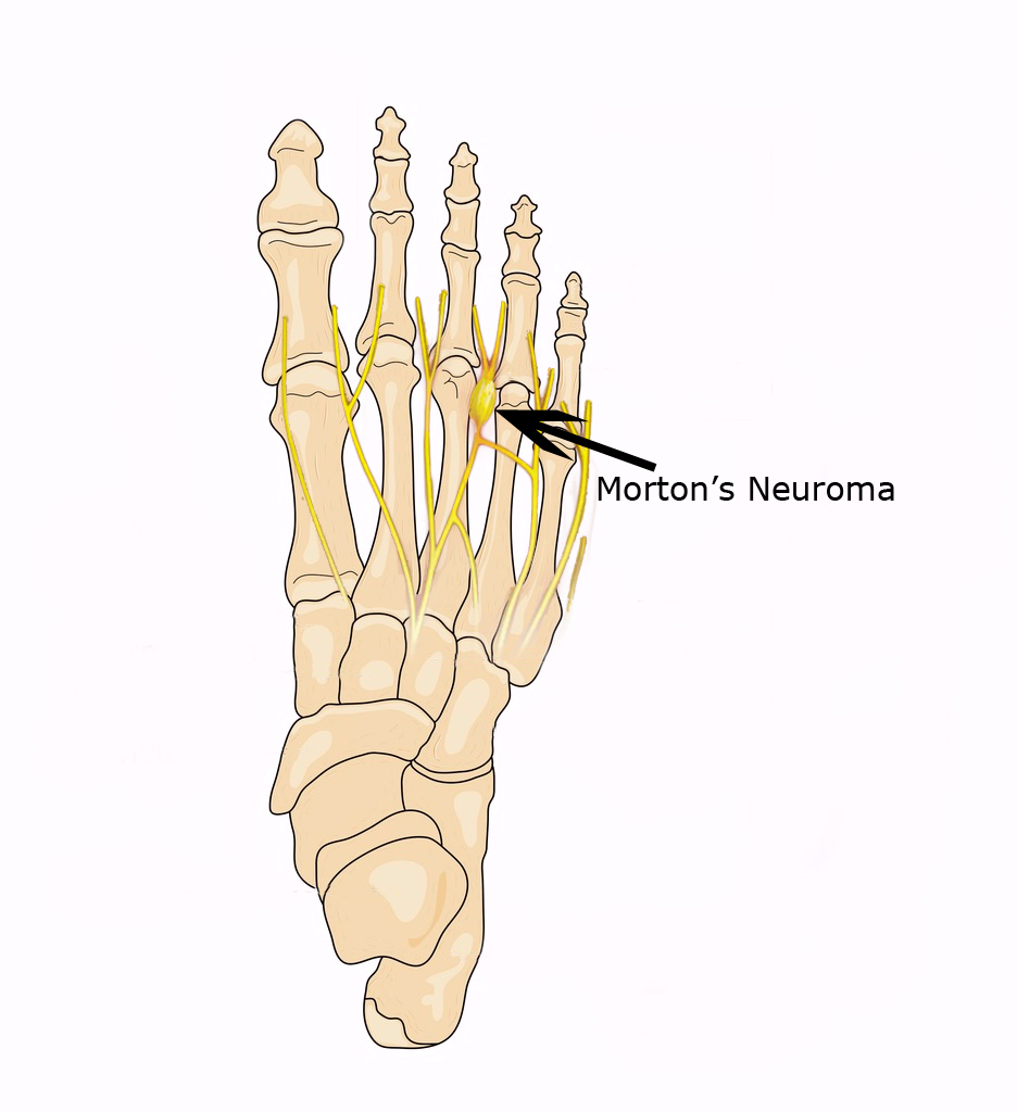 Foot bones with neuroma v01