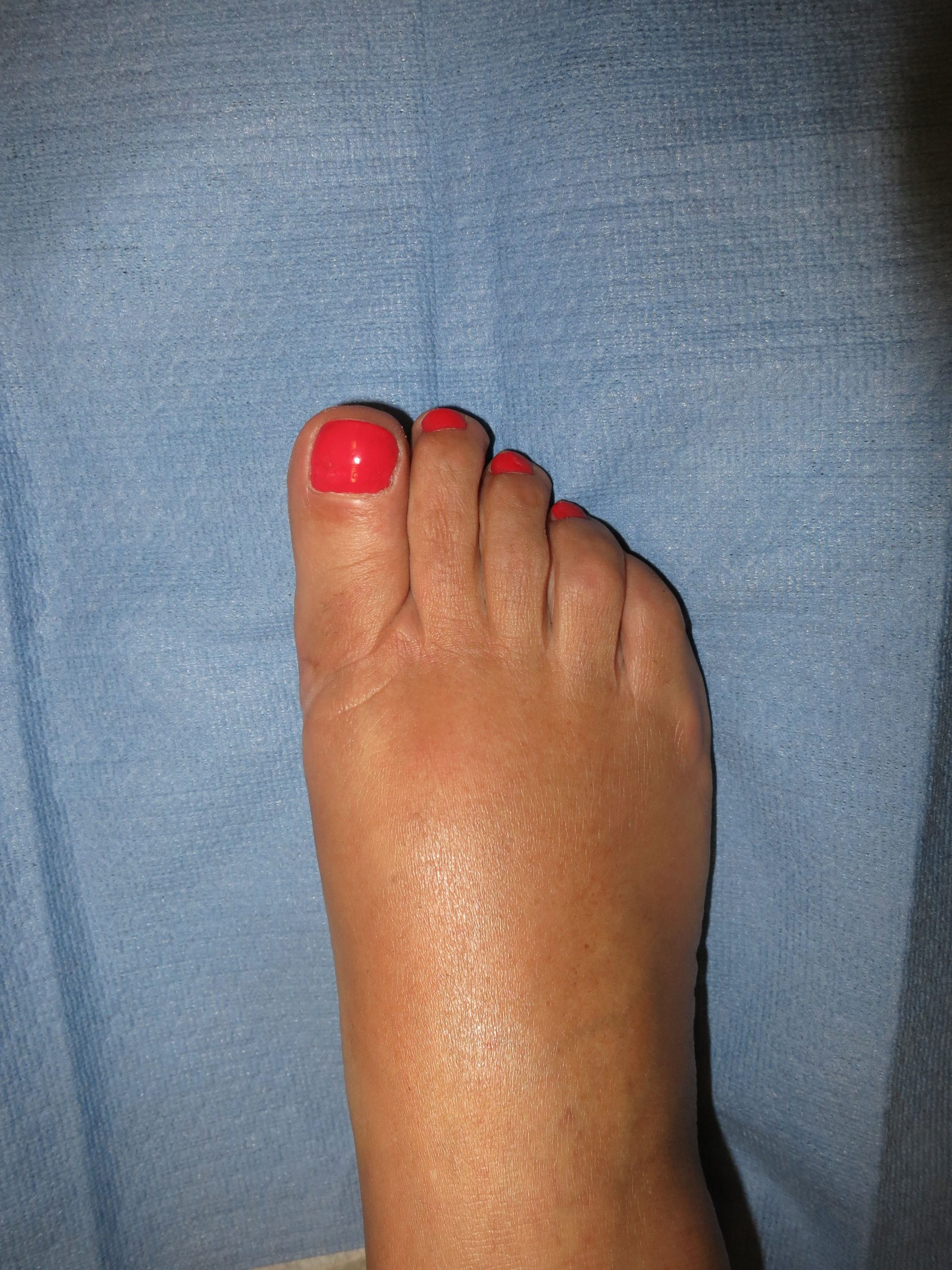 Postoperative bunion surgery at 8 weeks