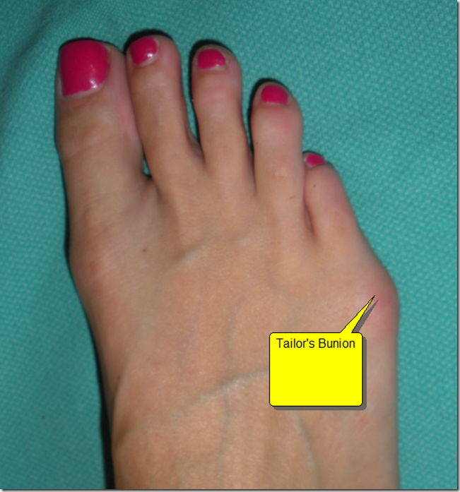 Tailor's bunion surgery