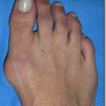 Bunion Surgery