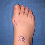 Bunion Surgeon Upper East Side